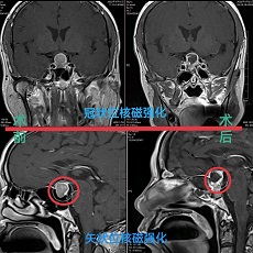 院内首例单鼻孔入路经蝶垂体腺瘤切除术成功完成