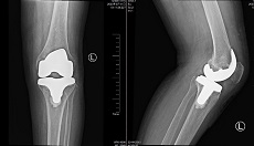 一个月，接连置换双膝关节，67岁大娘摆脱疼痛自如行走
