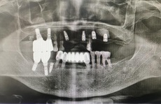 青滨附院口腔科成功完成院内首例上颌窦外提升植骨并同期种植手术