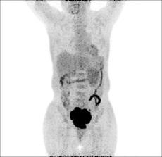 上新了 | PET-CT“引路”，肿瘤诊疗更精准