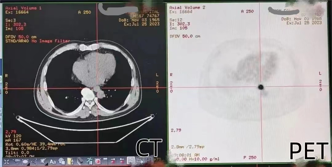 做完增强CT还要做PET-CT，过度检查还是真有必要？