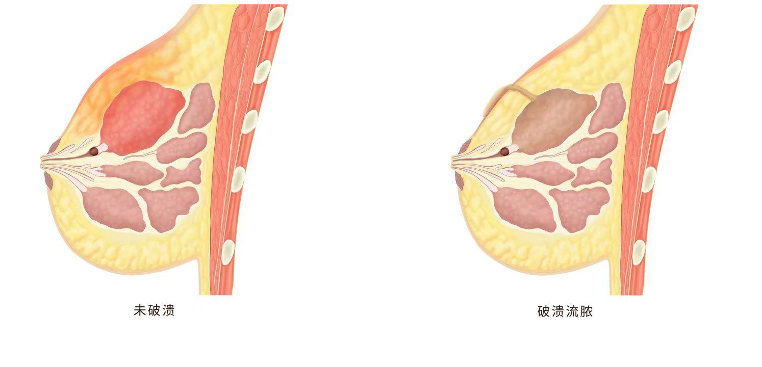个性化治疗解决患者3年非哺乳期乳腺炎困扰